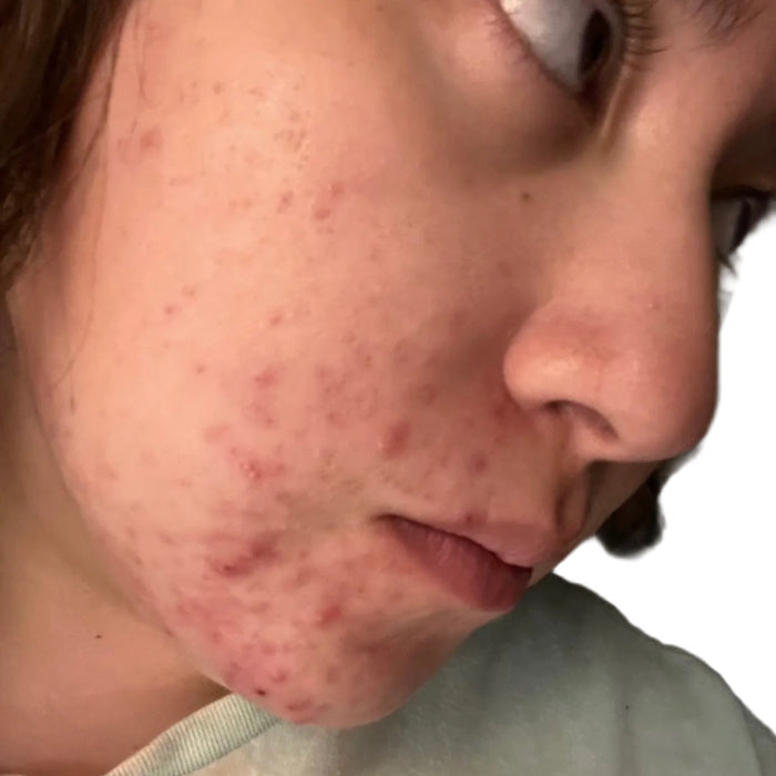 Before using Acne Defense Kit with 4-step skincare products for acne-prone skin